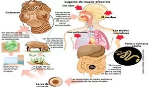 cisticerco de la tenia solium