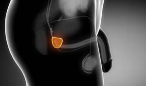 Cancer de prostata operacion consecuencias, Operacion cancer de colon complicaciones