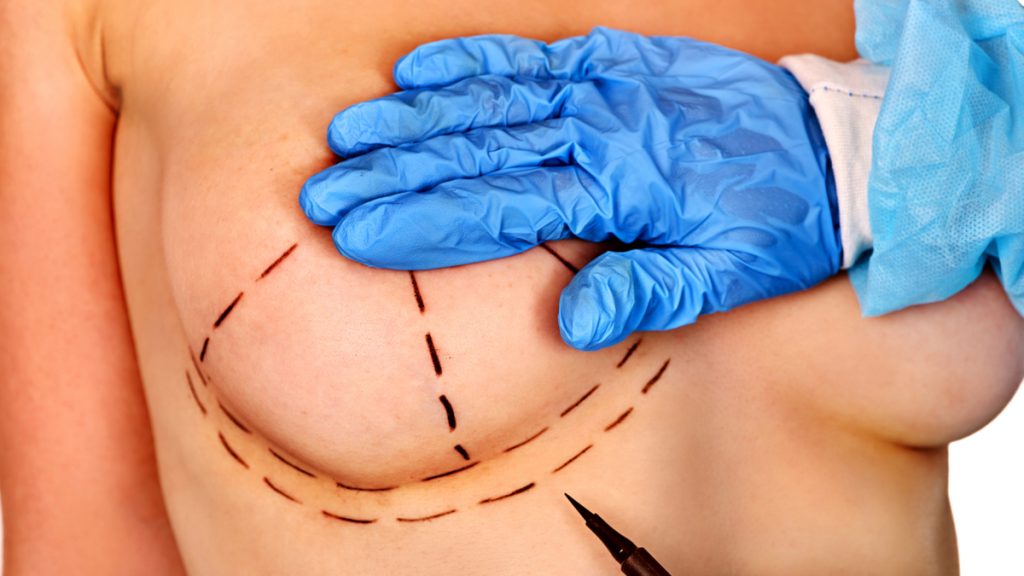 implante mamario