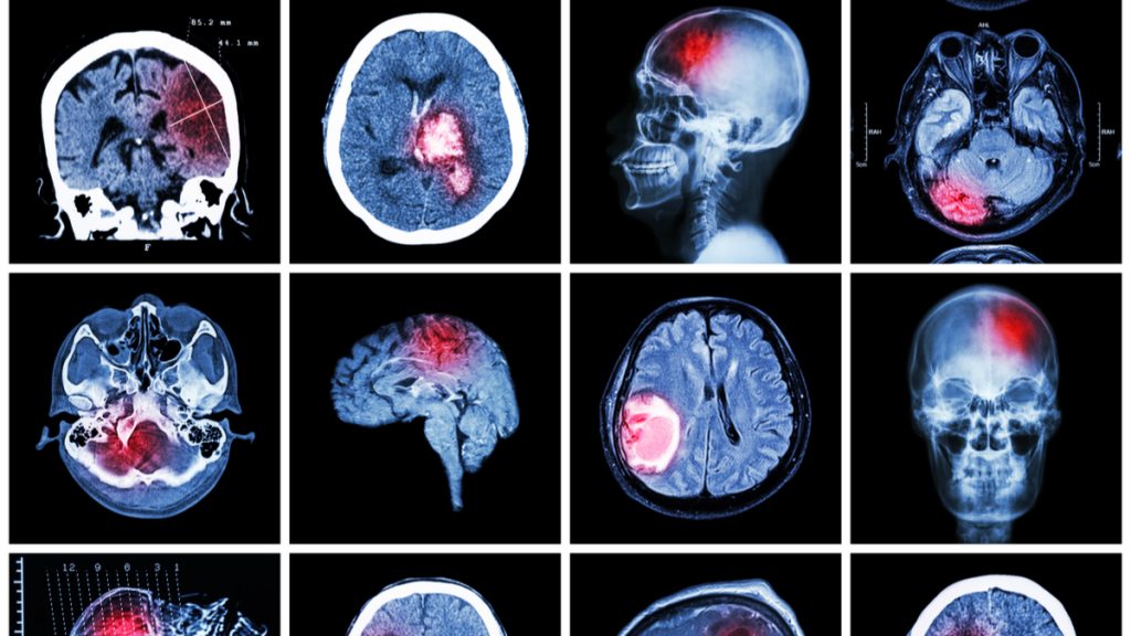 tumor en el cerebro