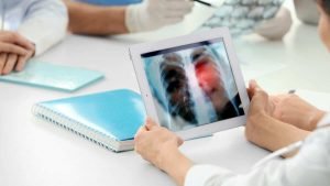 Más sobre la tamización del cáncer de pulmón con tomografía
