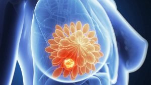 PALB2, otro gen en cáncer de mama hereditario