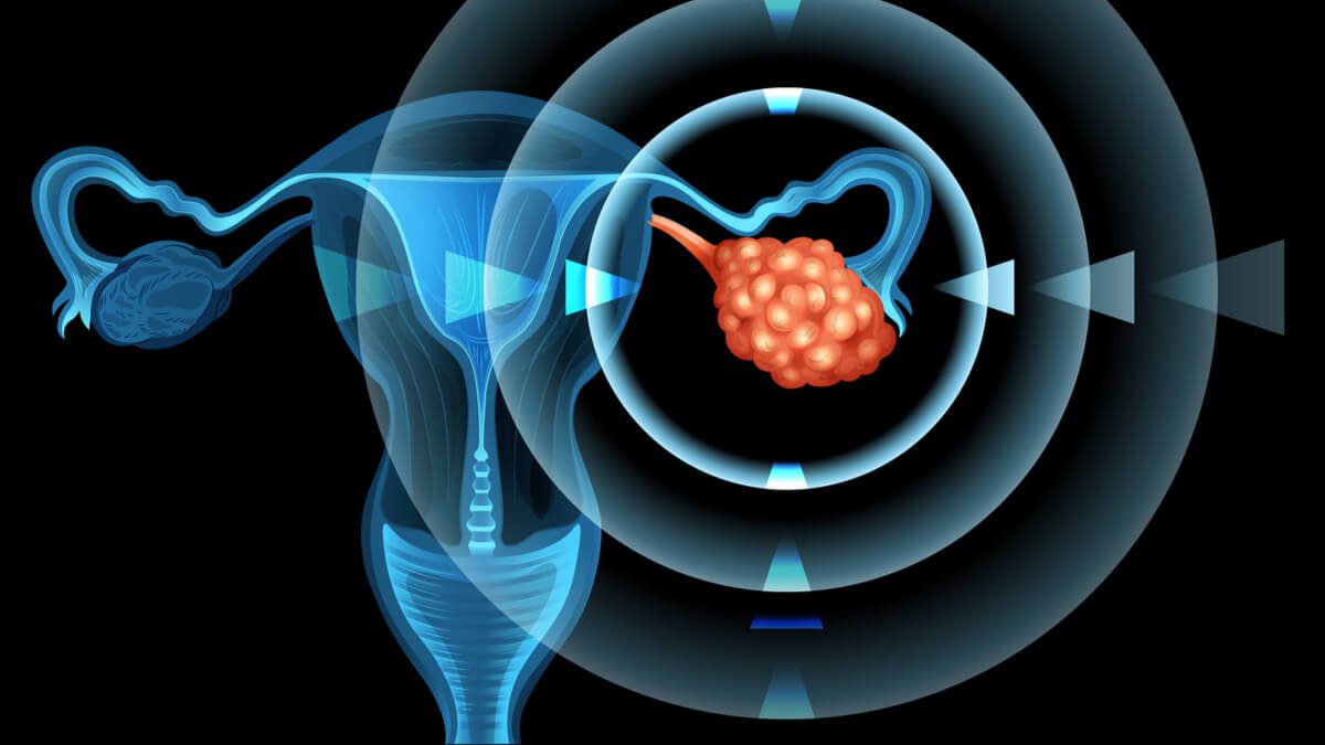 Grasas trans asociadas a un mayor riesgo de cáncer de ovario