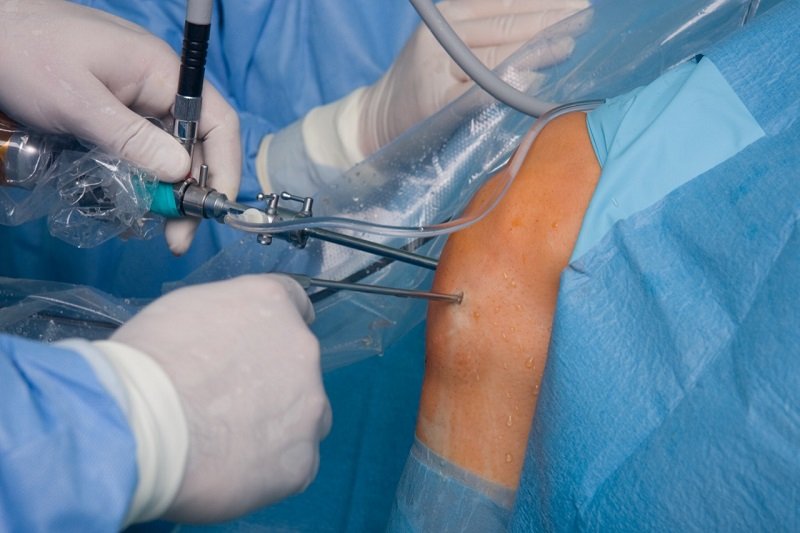 UIS presenta dispositivo para cirugía de ligamento cruzado