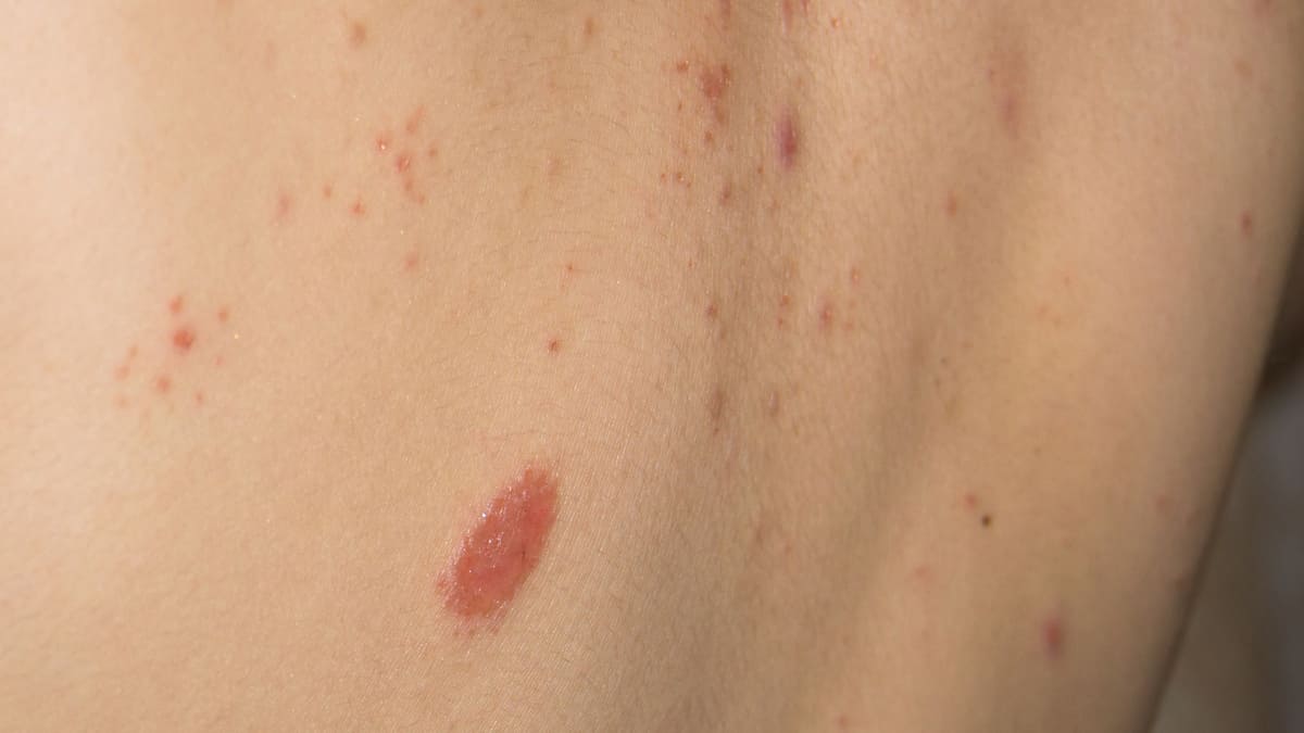 Dermatitis atopica, mas que una alergia en la piel