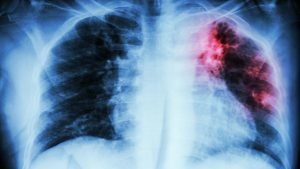 Por la pandemia se retrasa el objetivo de erradicar la tuberculosis mundialmente