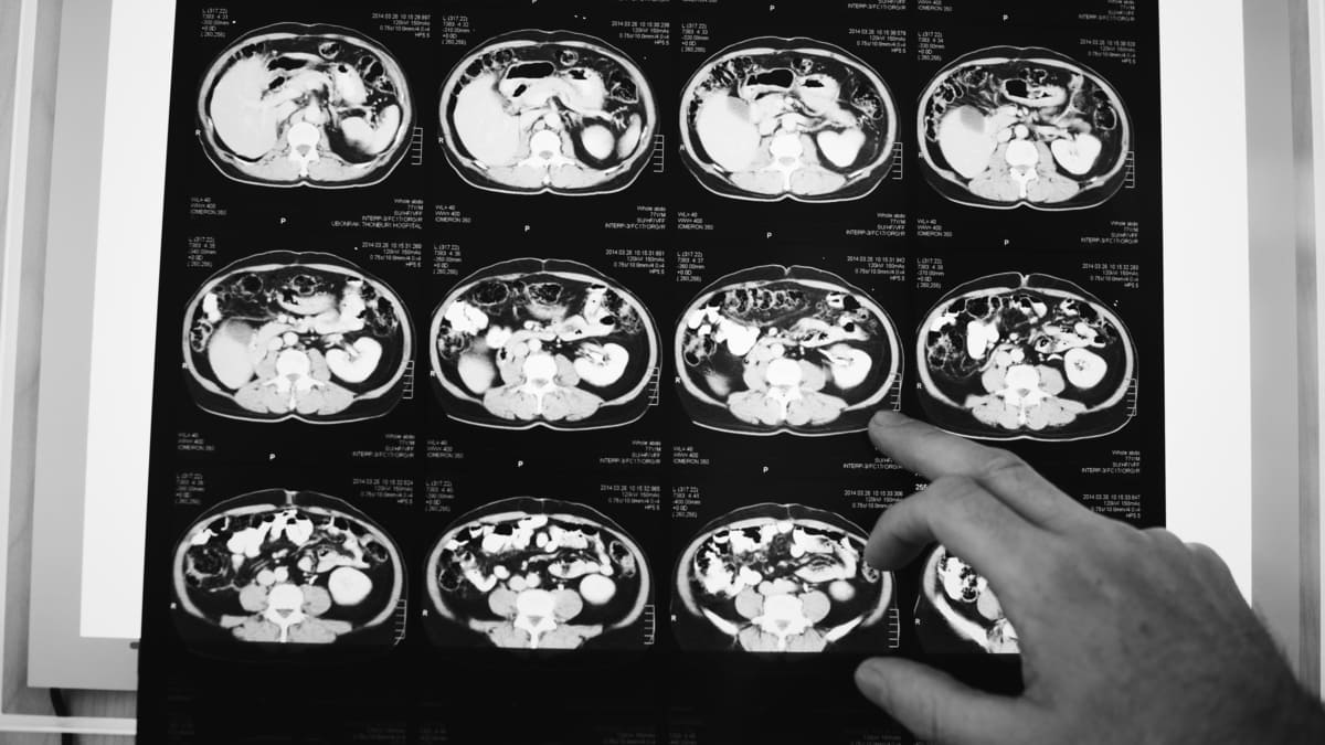 guia internacional tratamiento complicaciones tumores cerebrales