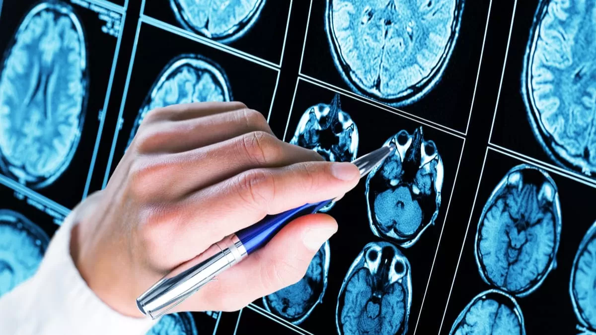 Hallan mutaciones asociadas al inicio precoz de la demencia