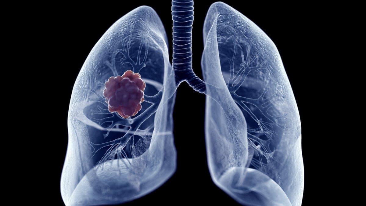 cancer de pulmón Nivolumab más ipilimumab