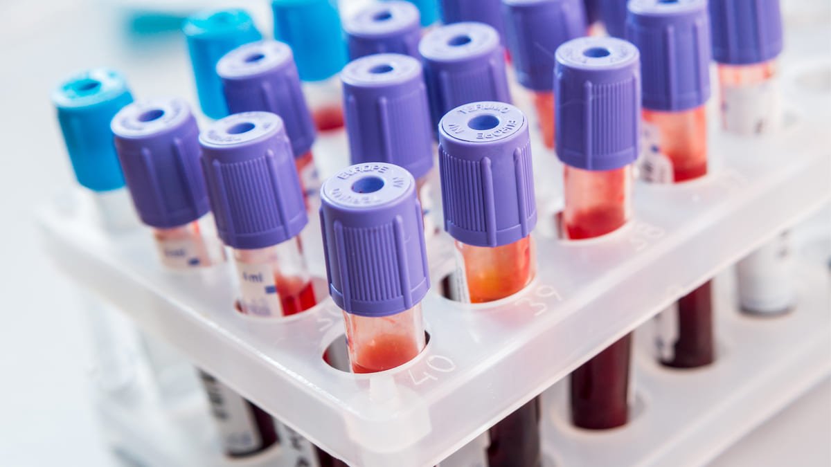 test sanguíneo rastrea avance del melanoma