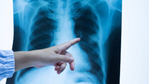 Diagnóstico de tuberculosis disminuyó entre 15% y 20% en Latinoamérica