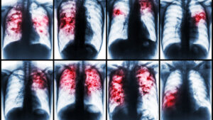 Tuberculosis la pandemia redujo el número de atenciones por la infección