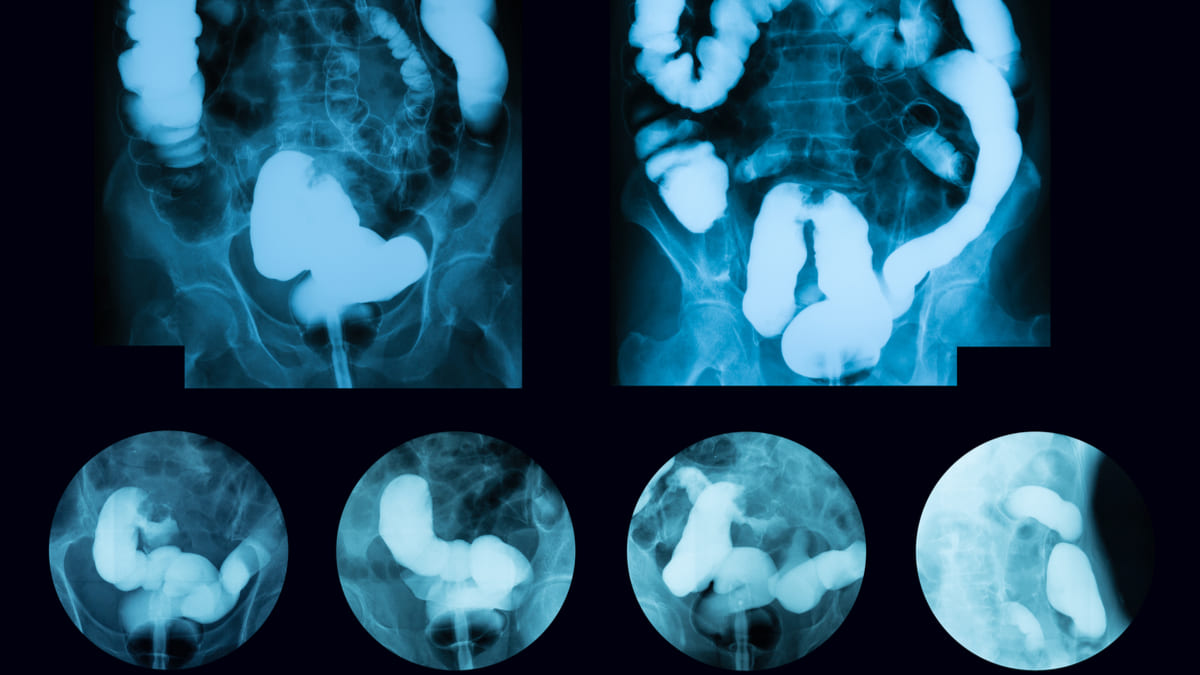 Científicos usan Inteligencia artificial para diagnosticar y tratar el cáncer de colon