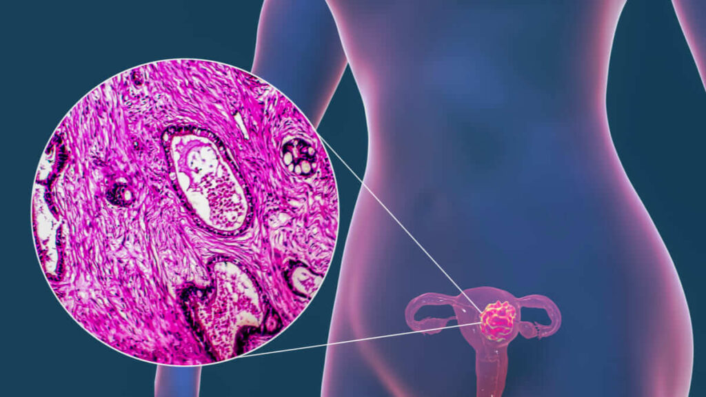 FDA aprueba nueva inmunoterapia para carcinoma endometrial