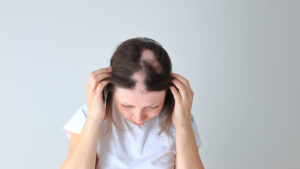 Medicamento de Eli Lilly para alopecia areata aprueba ensayos de fase III