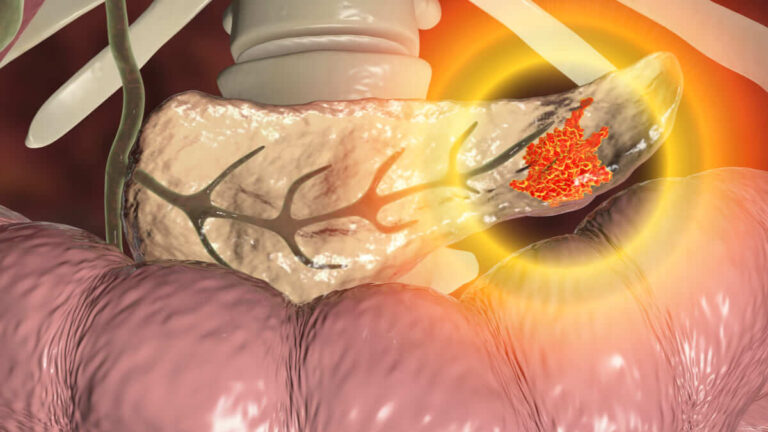 Medicamento inmunoestimulante muestra buenos resultados en cáncer de páncreas fase inicial