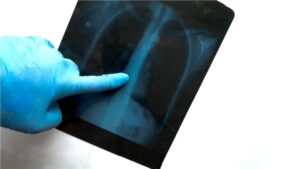 BIGDATA ENFERMEDAD PULMONAR OBSTRUCTIVA CRÓNICA -EPOC-