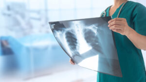 identifican genes perdida funcion pulmonar