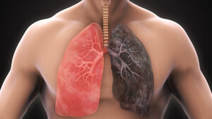 Dejar de fumar tras un diagnóstico de cáncer de pulmón ralentiza la progresión de la enfermedad
