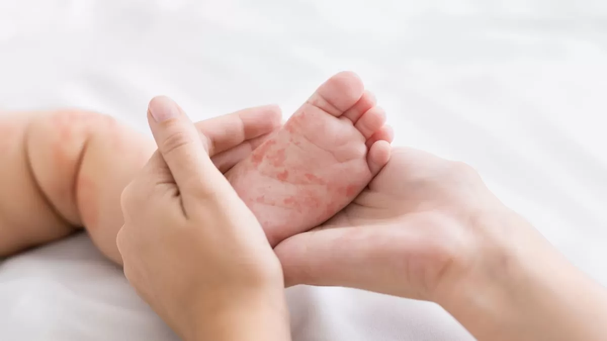 Crean pijama que alivia síntomas de dermatitis atópica en bebés