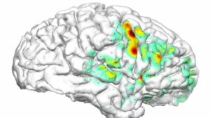 mapa de calor cerebral convulsiones. Crédito UCSF