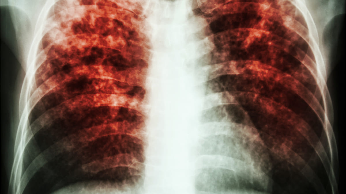 aumentan muertes por tuberculosis por primera vez en 10 años