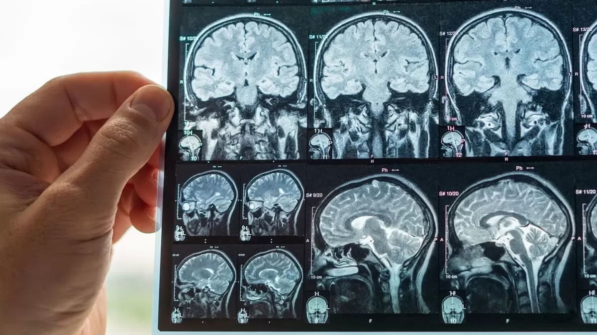 Rayos x tridimensionales podrian detectar enfermedad neurodegenerativa