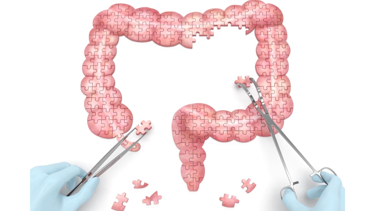 Rinvoq de Abbvie podría convertirse en el primer inhibidor para la enfermedad de Crohn