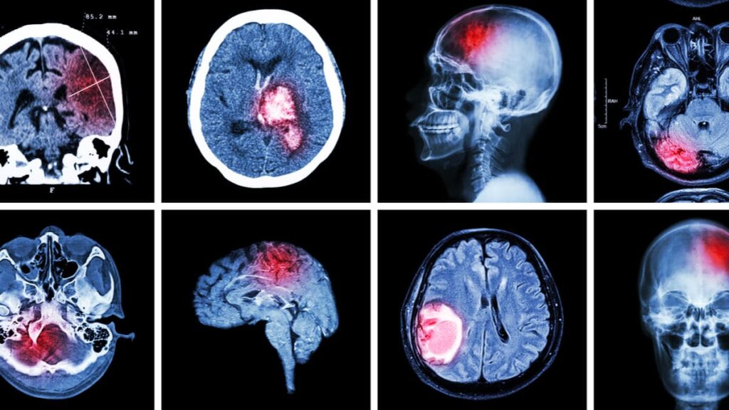 Biosensor mide progresion de lesiones traumaticas en el cerebro