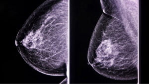 Banco de tumores facilita creación de terapias personalizadas en cáncer de mama