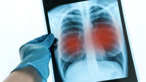 Colombia cuarto país de América con más casos de tuberculosis resistente