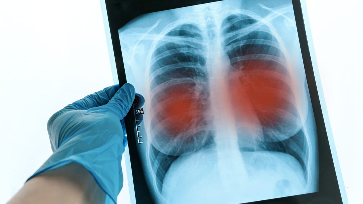 Colombia cuarto país de América con más casos de tuberculosis resistente
