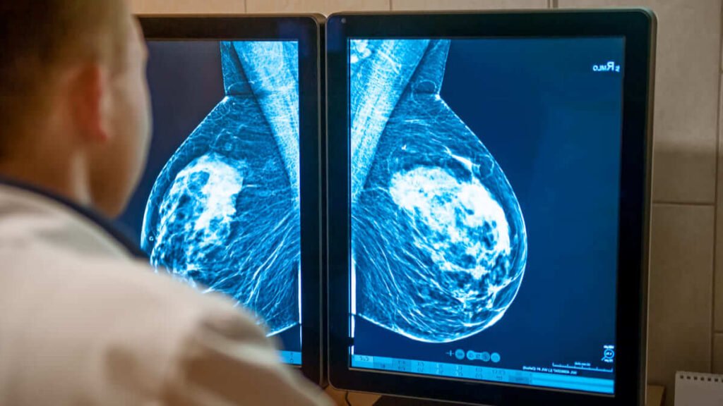 Medicamento frena el avance de un tipo de cáncer de mama en el 75,8% de pacientes
