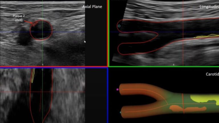 Técnica de ecografía 3D matrix identifica daños vasculares en personas sanas. Fuente JASS