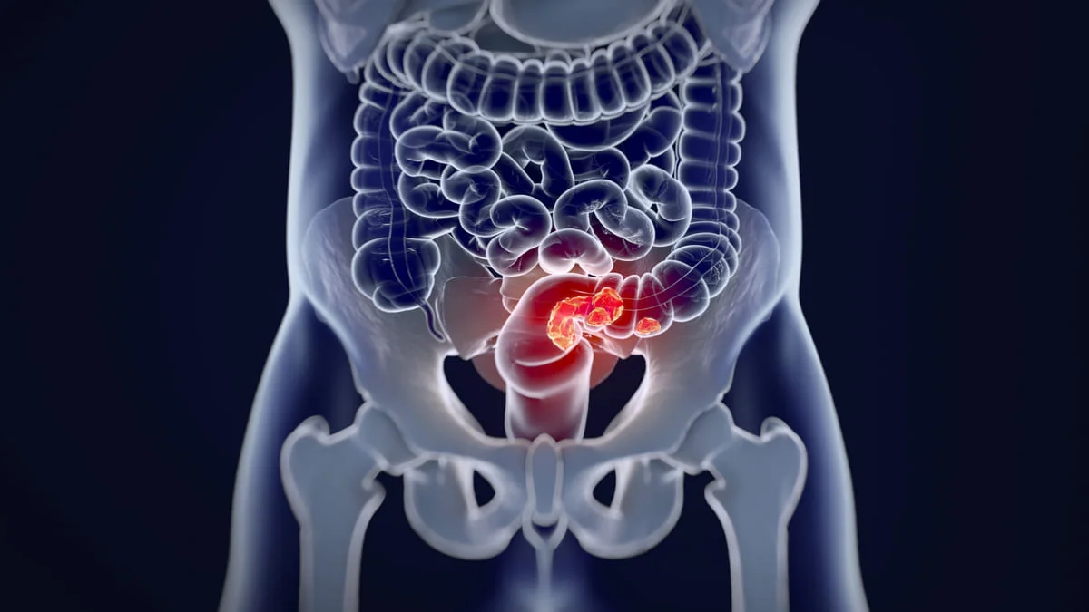 Cáncer de colón y recto ¿cómo está su situación en Colombia