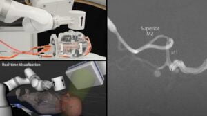 Crean sistema robótico con imanes para tratar ictus a distancia