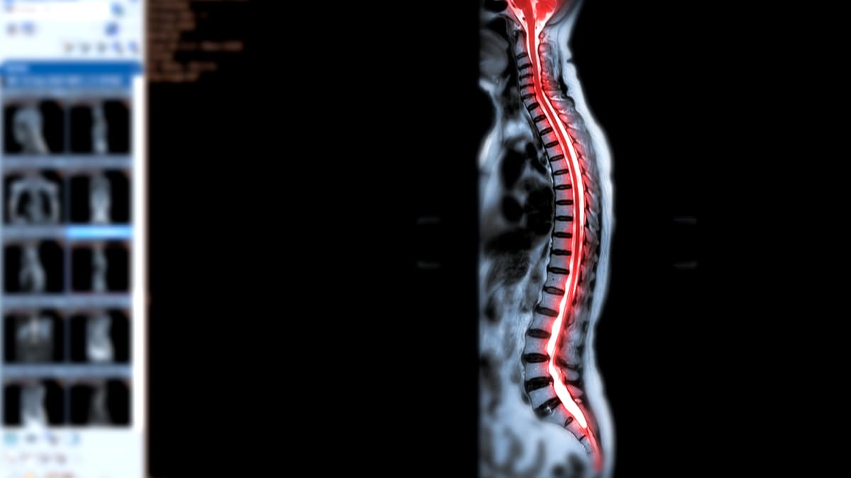 Reactivan los nervios de la médula espinal de paciente con enfermedad neurodegenerativa