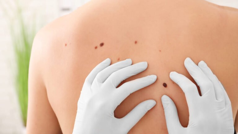 El principal obstáculo para la detección de un melanoma está entre el primer y segundo nivel de atención Dra. Paola Cárdenas