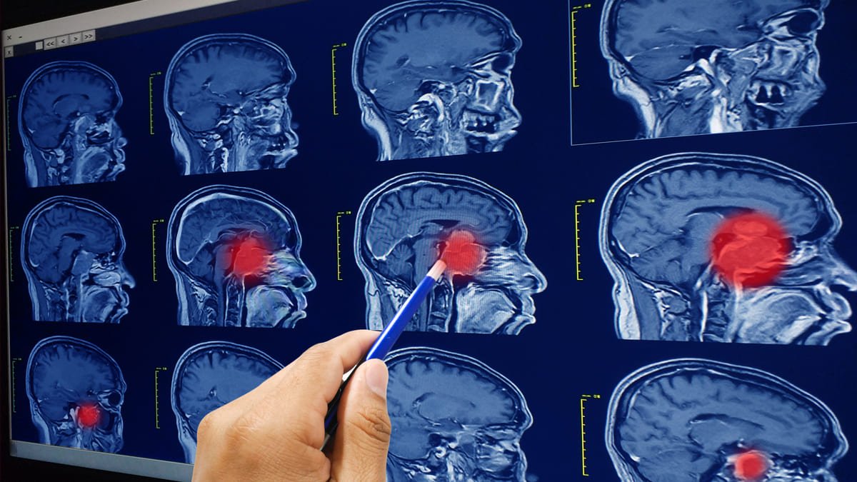 Identifican medicamento capaz de detener el crecimiento de tumores cerebrales recurrentes