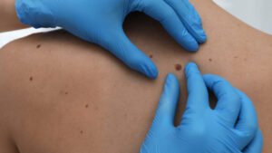 Melanoma en Colombia prevalencia y diagnóstico en 2021