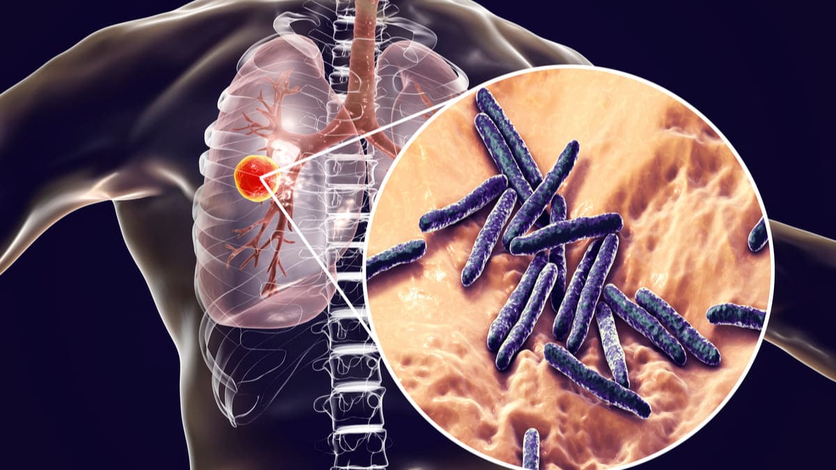 Washington registra su peor brote de tuberculosis en 20 años