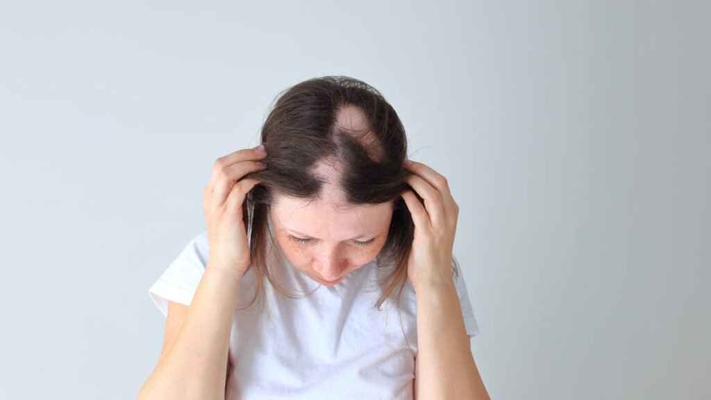 La FDA aprueba el primer tratamiento farmacológico para la alopecia areata