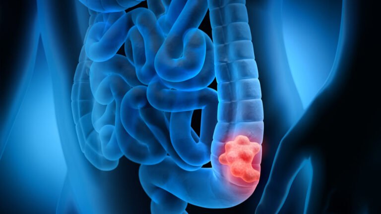 Descubren dos subtipos de cáncer colorrectal