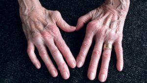 Casi 100.000 adultos padecen de artritis reumatoide en Colombia