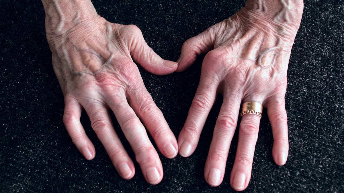 Casi 100.000 adultos padecen de artritis reumatoide en Colombia