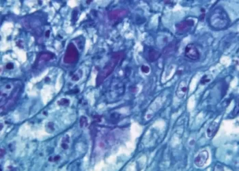 Casos de viruela símica crecieron el 20% en el mundo