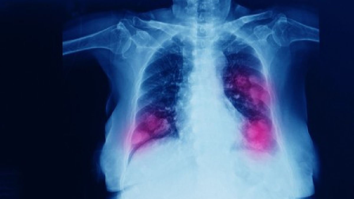 Bases de la herramienta técnica para cáncer de pulmón, diseñada por la CAC