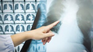 Cribado de cáncer de pulmón con tomografía aumenta la supervivencia global