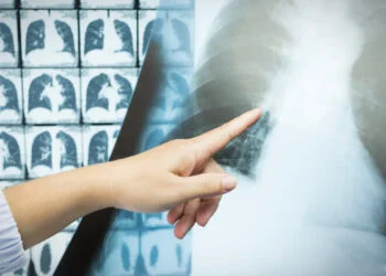 Cribado de cáncer de pulmón con tomografía aumenta la supervivencia global