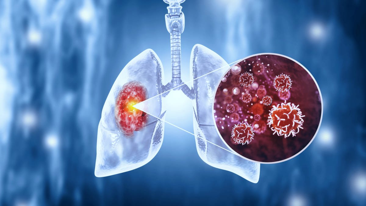 El 75% de casos de cáncer de pulmón se diagnostican en estadíos avanzados CAC